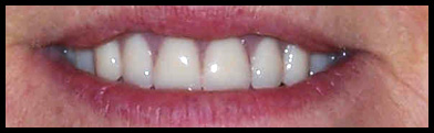 dentures_1a
